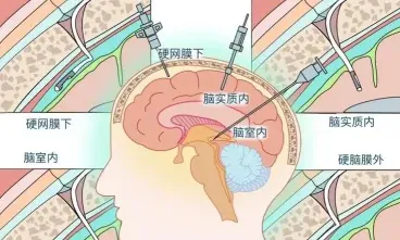 颅内压